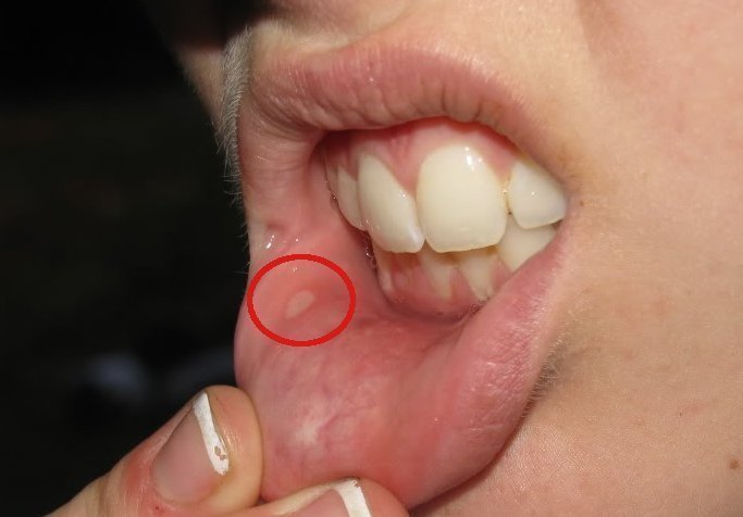 canker sore on lip. is it possible? | Yahoo Answers