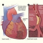 Symptoms of Arterial Blockage in the Heart