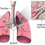 Pneumonia Symptoms